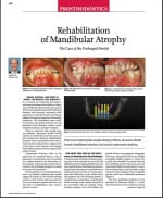 rehabilitation-of-mandibular-atrophy-a-e1454102959748