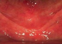 Case Studies | Jaw Bone Density Issues | Hampton Dental Associates