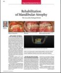 Rehabilitation of Mandibular Atrophy a e1454102959748