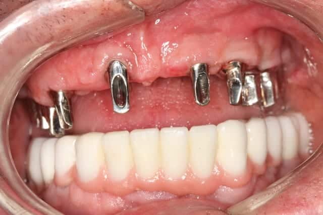 Post Dental Restoration Gums and bottom teeth