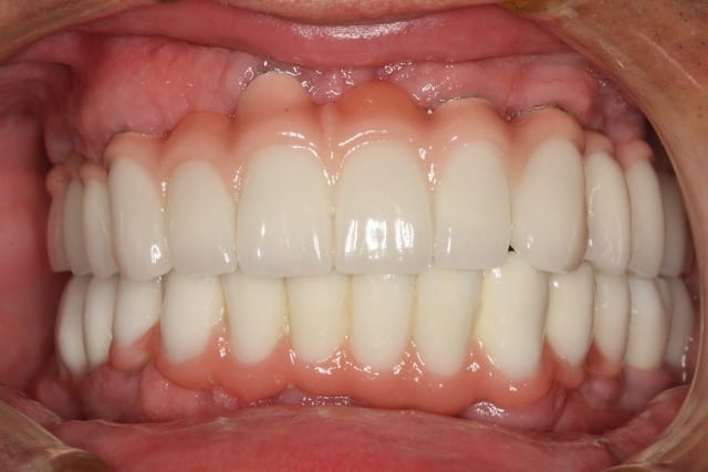 Dental Restoration Teeth