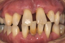 advanced gum loss closeup1