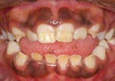 amelogenesis imperfecta 1