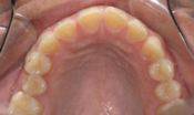bulimia55