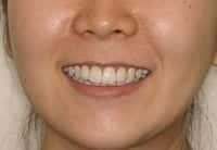 captek facial