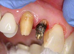 cemented crown remove