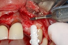 chin block 3