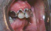 denturecloseup2