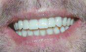 denturecloseup3