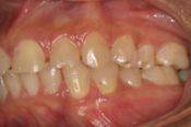 enamel bulimia purging enamel damage Hampton Dental Associates