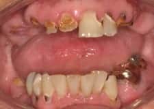 erosion implants 1