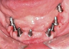 erosion mandibular implants 1