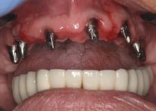 erosion maxillary implants