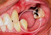 extraction bone lossmore