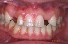 genetic missing teeth 1