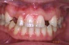 genetic missing teeth