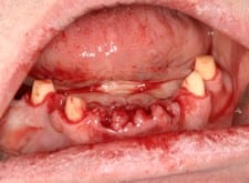 jw diseased mandible extractions