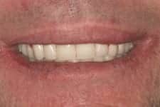 jw gum disease temporary teeth