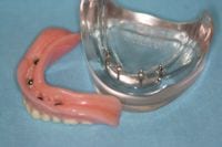 Hampton Dental Associates dentures 1