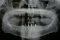 mini implant3