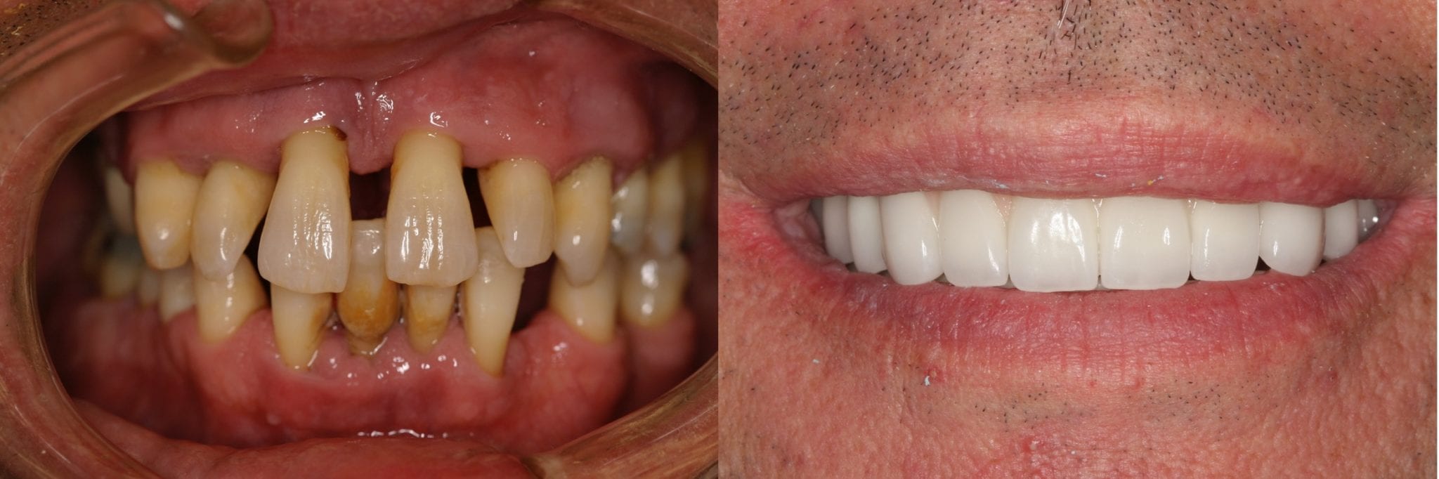 close up before and after of one day implant