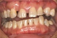 orthodontics periodontitis