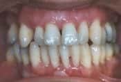 overdenture before22