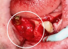 partial cyst bone hole2