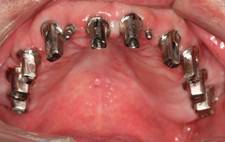 pelman final maxilla implants