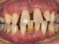 periodontitis bone loss