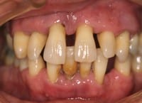 periodontitis bone resorption