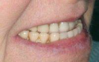picture of person smiling with prosthodontic bite