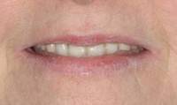 person slightly smiling with prosthodontic bite