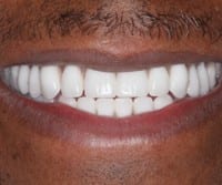 prosthodontic function 2