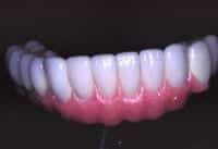 rehab porcelain fused gold bridge 1