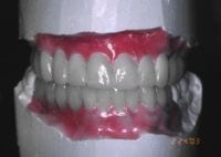 rehabilitation waxup model Hampton Dental Associates