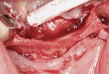 ridgesplit surgery