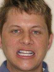 veneer replacement1
