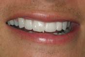 veneer replacement5