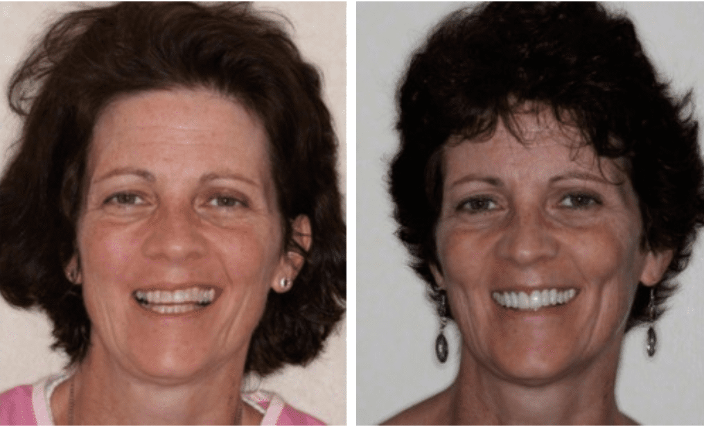 reconstructive dentistry before and after image
