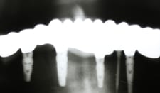 xray cantilevered bridge