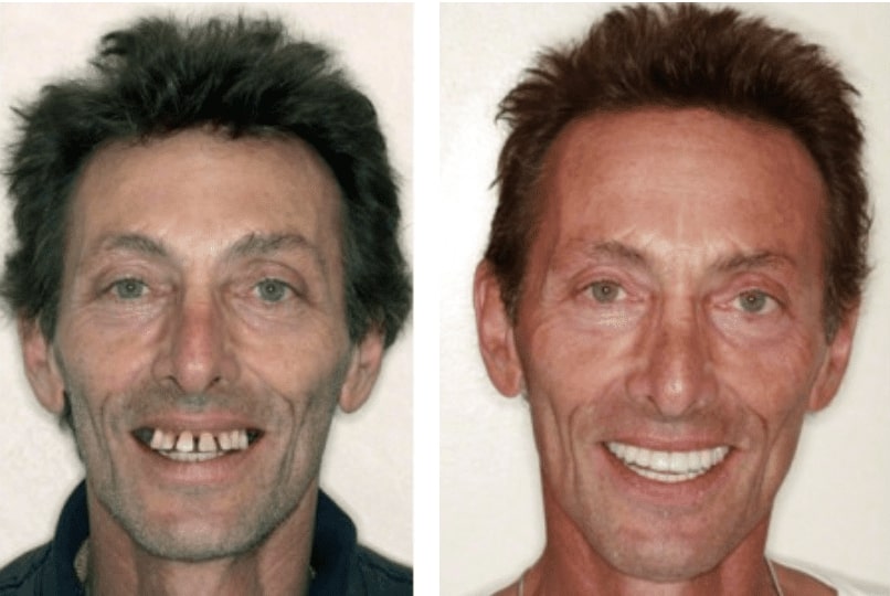 Fixed Dentures in Milwaukee WI Hampton Dental Associates 1