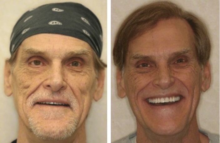 Before and after dental implants