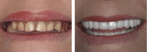 dentures winterba