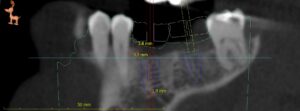 Before Image: Implants to Replace 2 Teeth