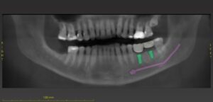 After Image: Implants to Replace 2 Teeth