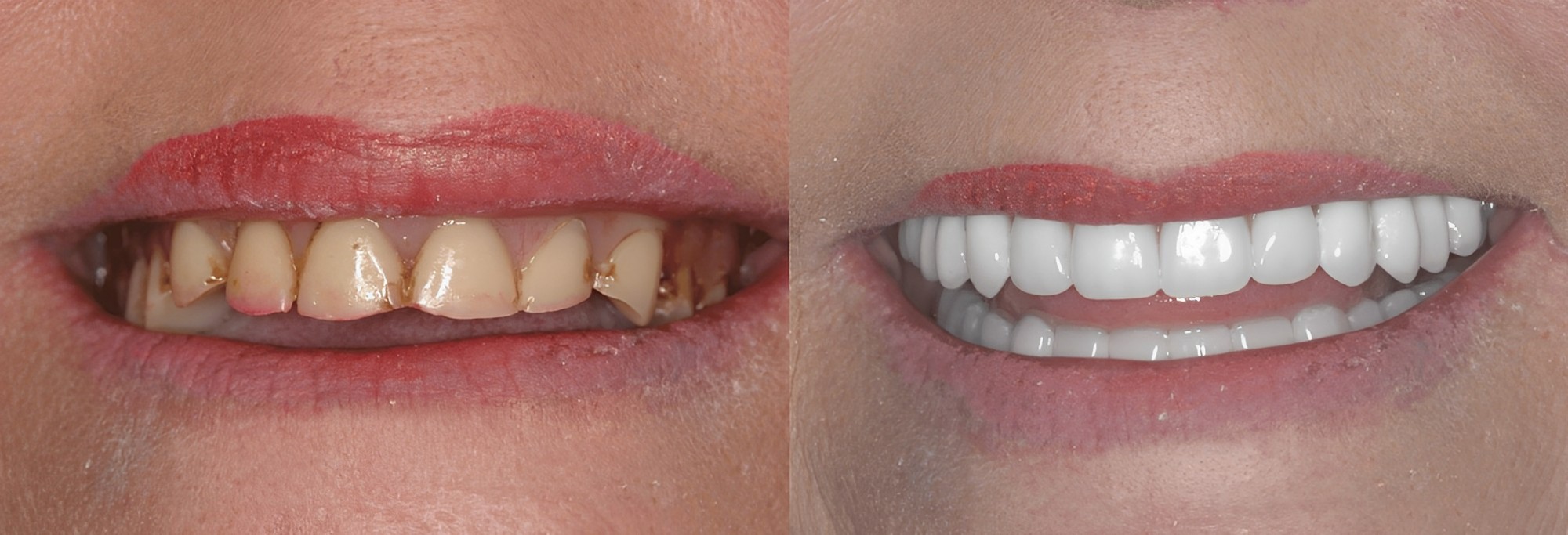 Dentures patient
