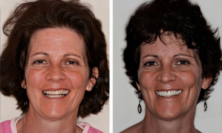 Smile Makeover before and after