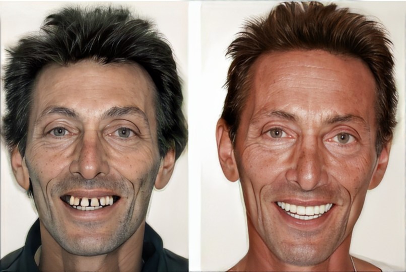 man smiling before and after fixed dentures, smile much fuller and healthier after