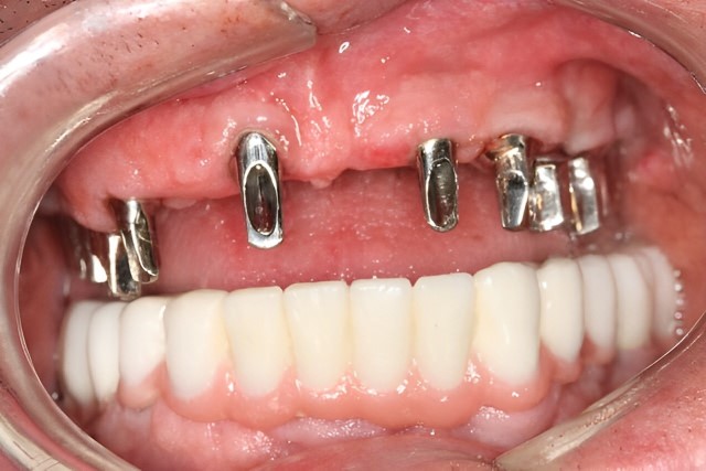 Post Dental Restoration Gums and bottom teeth